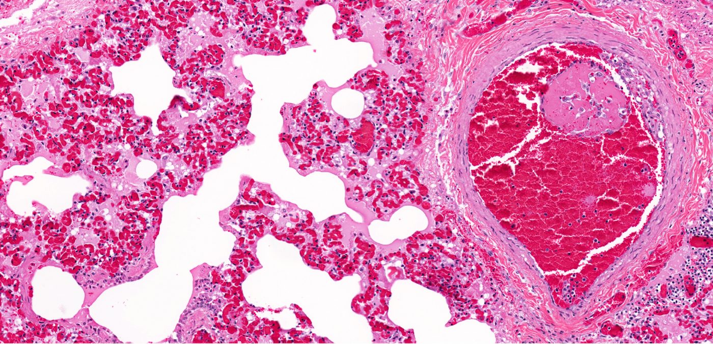Diffuse Alveolar Haemorrhage Reduces SLE Patients’ Long-term Survival