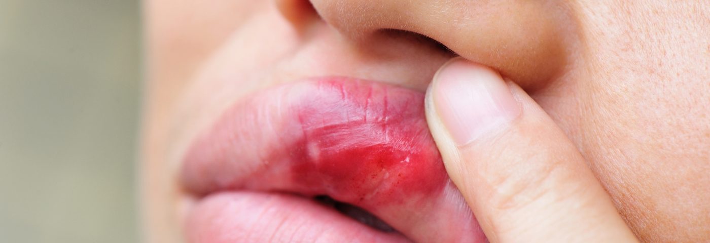#EULAR 2016: Mouth Ulcers in Lupus May Be Caused by Altered Genetic Pathway