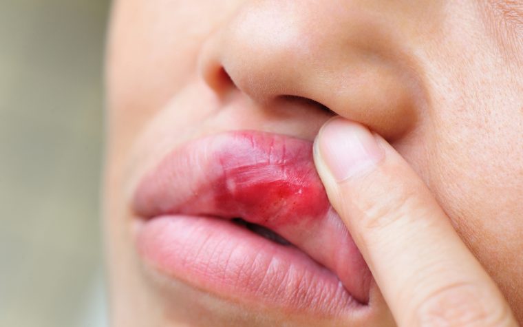Mouth ulcers and lupus