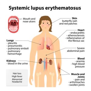 lupus symptoms