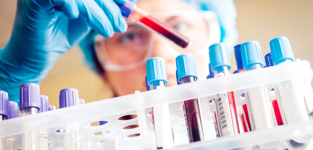 Specific Antibody in Blood May Be Biomarker of Kidney Disease in Lupus Patients