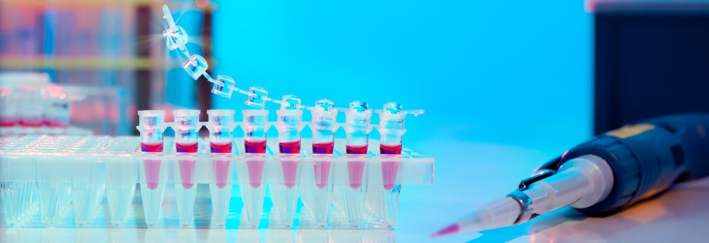 Blood Profiling May Help Identify Lupus Patients at Risk of Kidney Failure