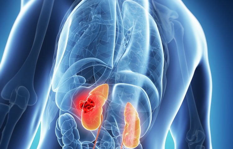 Lupus Nephritis Patients’ Lack of Response to Initial Therapy Can Predict Kidney Issues, Disease Severity