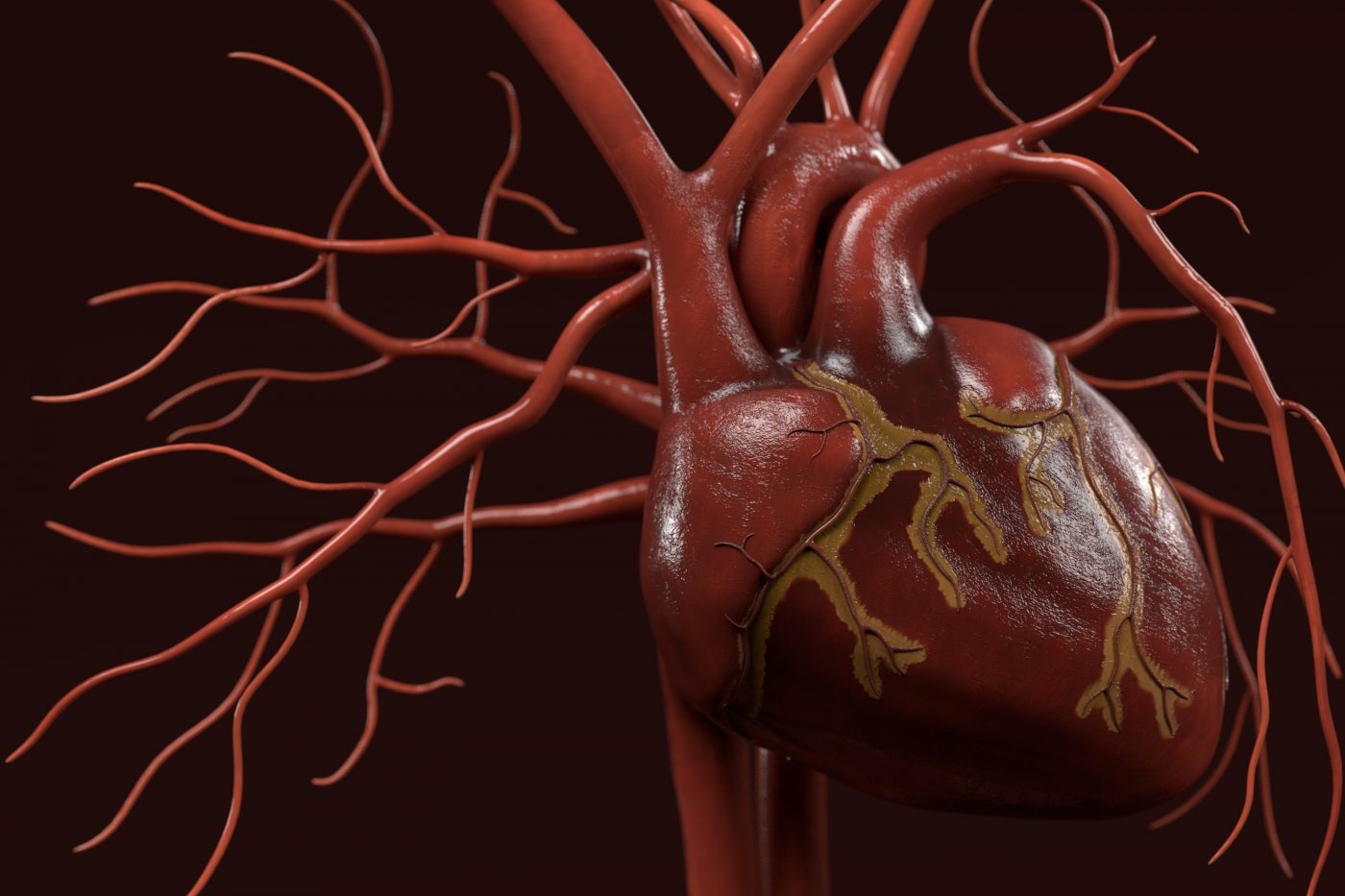 Lupus myocarditis study