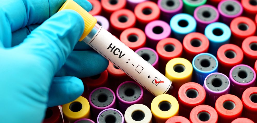 Lupus Patients Have Higher Rate of Chronic Hepatitis C Virus, Study Finds