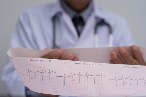 Early Detection of ECG Anomalies in SLE Patients May Prevent Heart Disease