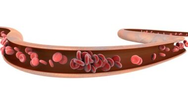 thrombosis embolism SLE