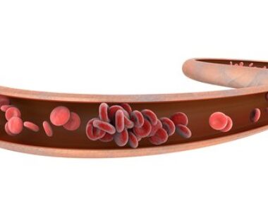 thrombosis embolism SLE