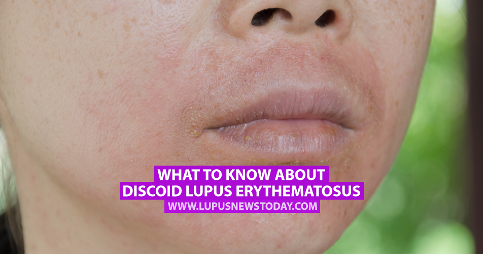 What To Know About Discoid Lupus Erythematosus Lupus News Today