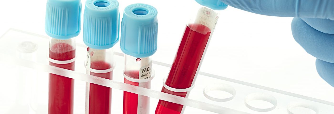 Exagen Diagnostics Develops Blood Test to Monitor Lupus and Lupus Nephritis