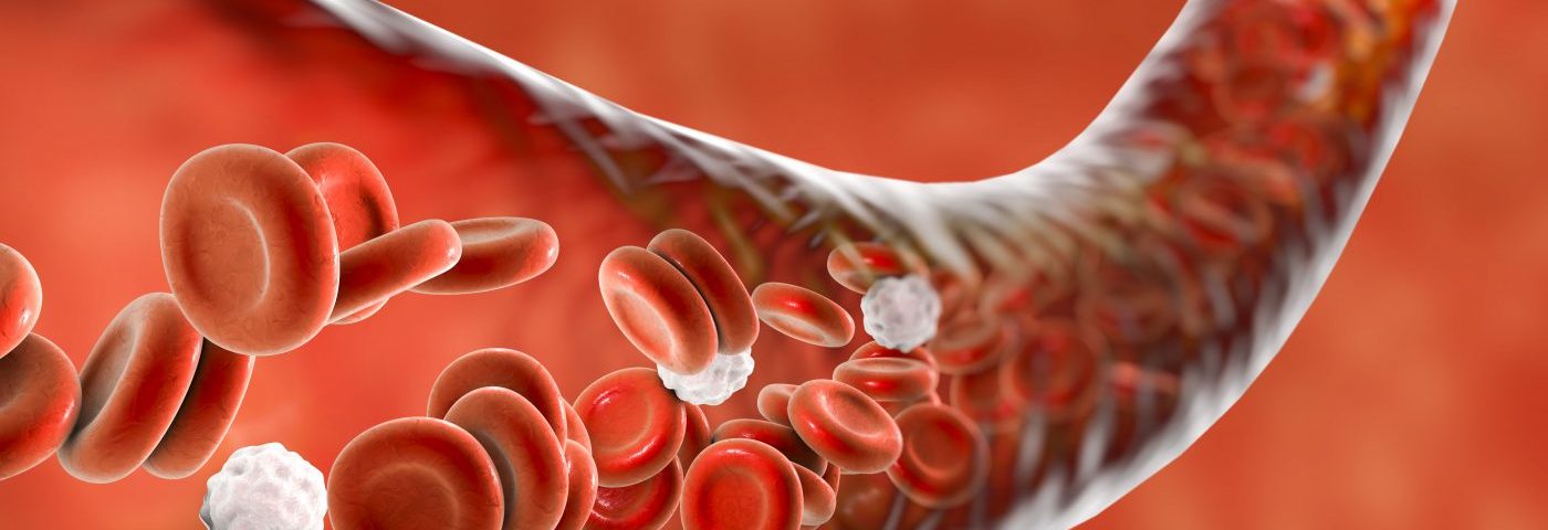 Anemia and Low Lymphocyte Numbers Are Most Common Blood Disorders in Lupus Patients, Study Finds