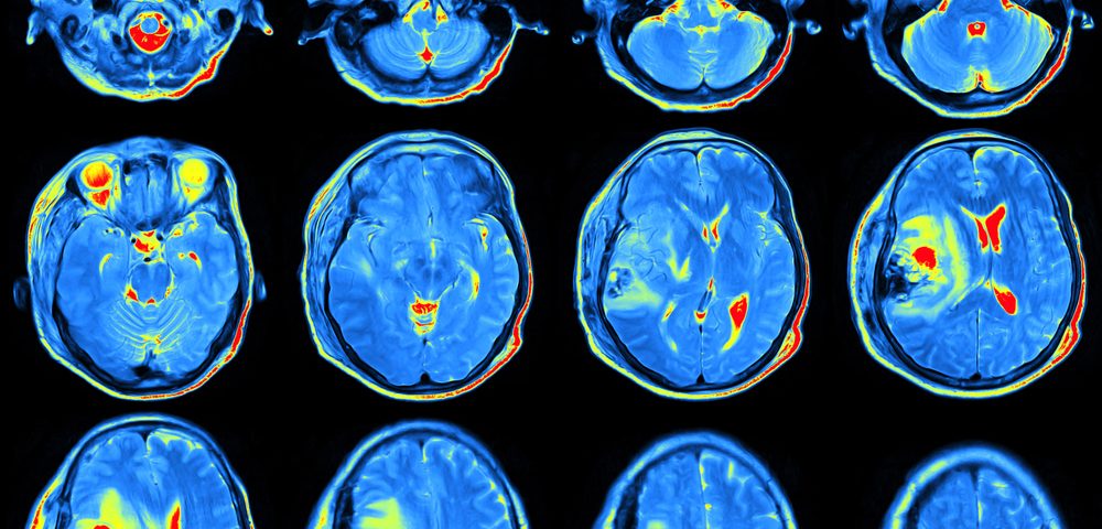 Rituxan Could Be Therapy in Lupus Patients with Neurological Issues