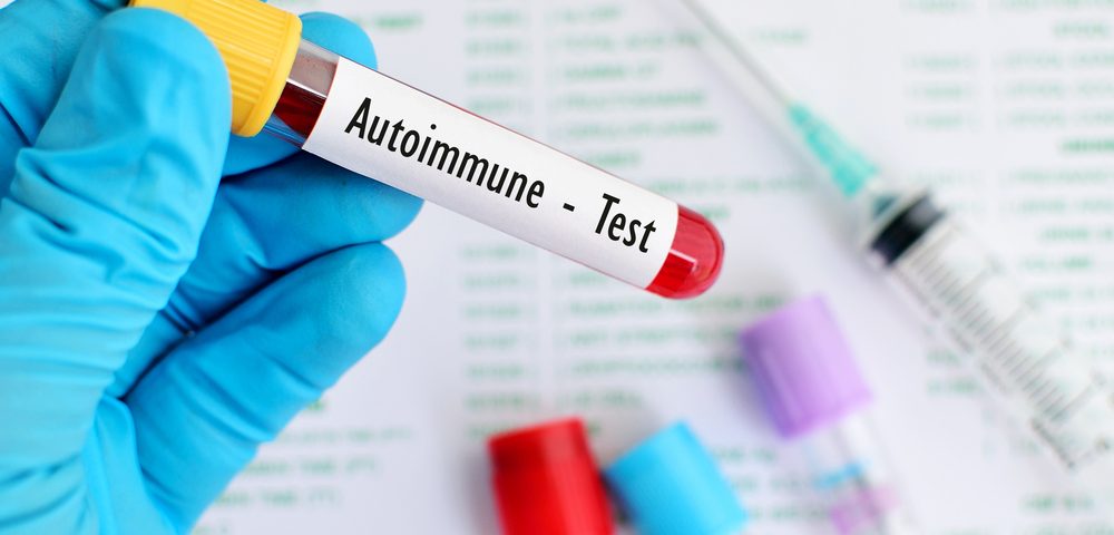 Certain Autoantibodies May Help Identify Lupus Patients at Risk for PAH, Research Finds