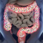 Gut bacteria, pregnancy and lupus
