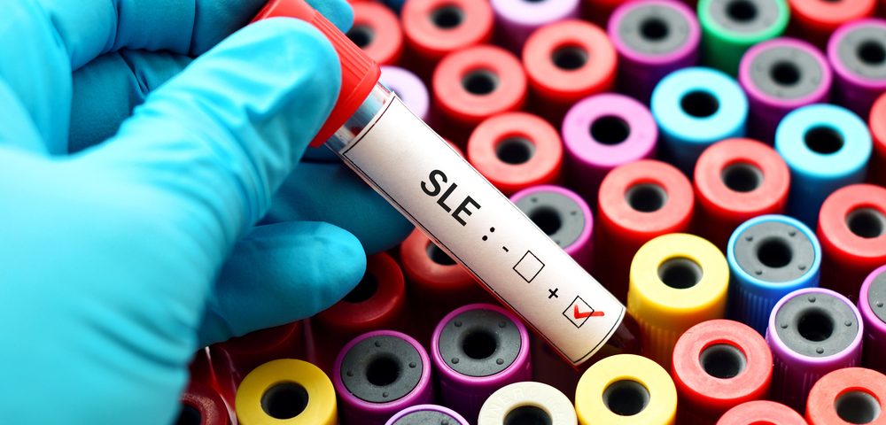 Combination of Biomarkers May Better Predict SLE Disease Activity, Study Suggests