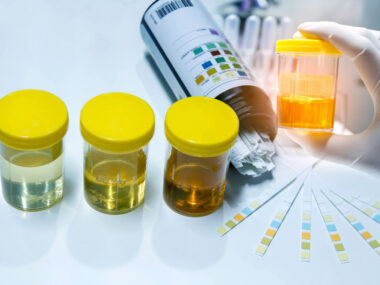 protein levels in urine