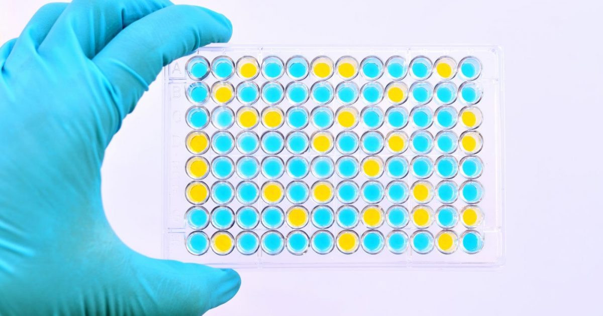 Simple Blood Test Predicts Lupus Nephritis Flareups in SLE, According