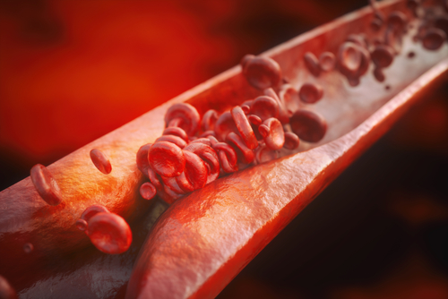 Lupus Patients More Likely to Develop Atherosclerosis, Study Suggests