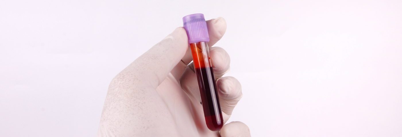 Blood Levels of Galectin-9 May Help Spot SLE Patients with More Severe Disease, Study Suggests