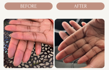 Two side-by-side photos, labeled "Before" and "After," show a woman's fingertips. In the "before" photo, the tips of her fingers have a purplish color. The discoloration isn't visible in the "after" photo.